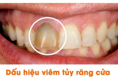 Tủy răng hoại tử là gì? Cách điều trị như thế nào?